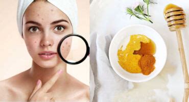 Zostava prírodných ingrediencií vhodných na domácu liečbu akné