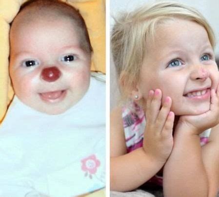 Detská koža s rôznymi typmi materských znamienok.