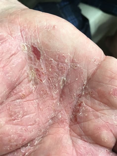 Ilustrácia dlaní s drobnými pľuzgiermi charakteristickými pre dyshidrotický ekzém