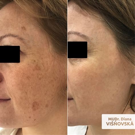 Porovnanie pleti pred a po procedúre fotorejuvenizácie s dôrazom na zjednotenie tónu a redukciu pigmentácií