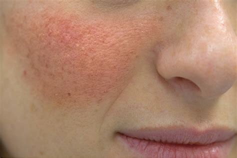 Ilustrácia pokožky hlavy dieťaťa s prejavmi seboroickej dermatitídy