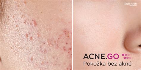 obrázok pokožky s akné pred a po aplikácii prírodného prípravku