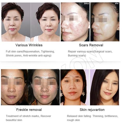 vizualizácia procesu frakčného CO2 laserového resurfacingu na koži