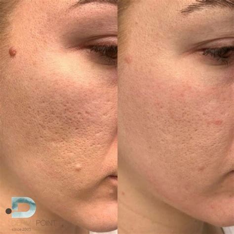 porovnanie pleti pred a po ošetrení frakčným CO2 laserom