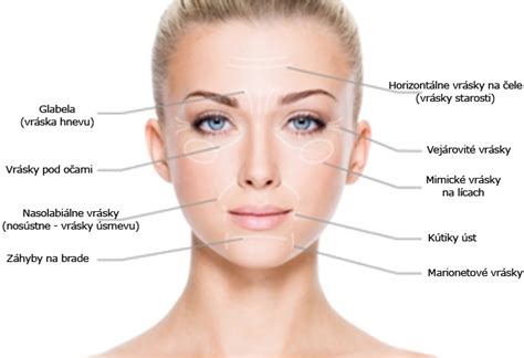 Infografika zobrazujúca rôzne oblasti tváre, kde sa aplikuje botox, s označením typických vrások.