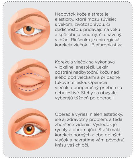 Infografika znázorňujúca rôzne typy očných operácií