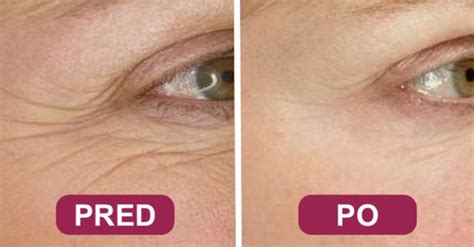 Ilustračná fotografia ženy s pleťou vykazujúcou známky starnutia, jemné vrásky okolo očí a úst.