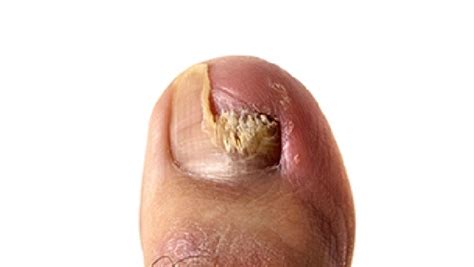 Ilustrácia plesňovej infekcie nechtov