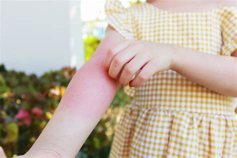 Obrázok ukazujúci typické začervenanie a pľuzgieriky pri kontaktnej dermatitíde na rukách