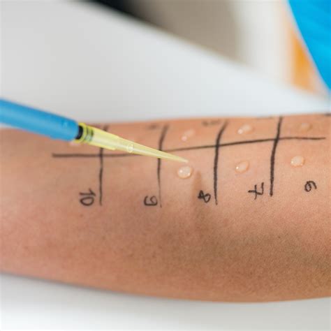 Ilustrácia lekára vykonávajúceho kožný vpichový test (prick test)