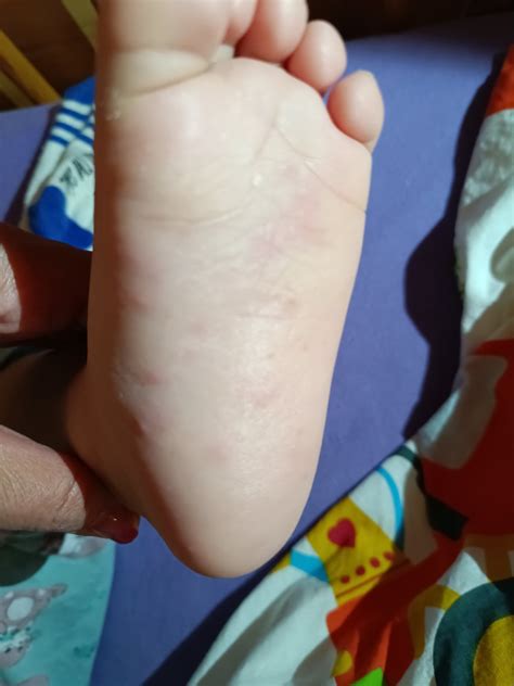 Detail pokožky s typickými chodbičkami a vyrážkami pri svrabe