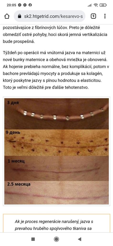 Infografika znázorňujúca rôzne typy jaziev po cisárskom reze (horizontálna, vertikálna, keloidná, hypertrofická, atrofická).