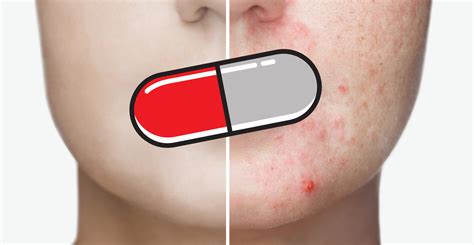 Ilustračná fotografia rôznych typov liekov na akné dostupných v lekárni