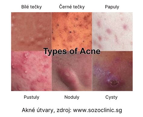 Infografika znázorňujúca rôzne typy akné a ich prejavy.