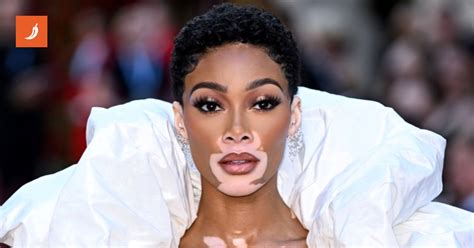 Detailná fotografia tváre osoby s vitiligom, zvýrazňujúca biele škvrny okolo úst a očí.