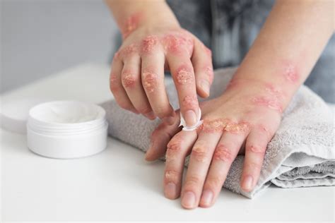 Infografika porovnávajúca rôzne kožné ochorenia ako vitiligo, atopická dermatitída, psoriáza a ich reakcie na slnko.