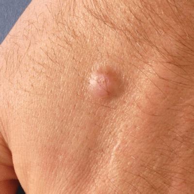 Tvrdý kožný fibróm (fibroma durum)