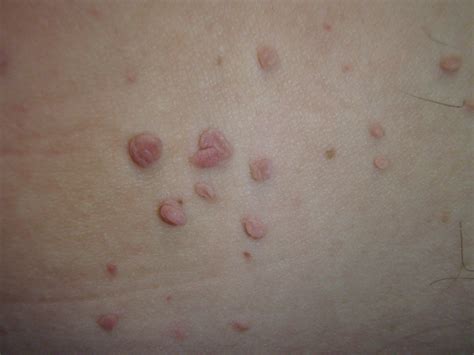 Mäkký kožný fibróm (fibroma molle)