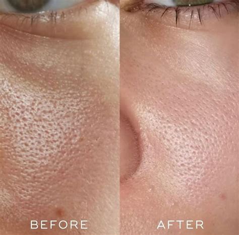 Ilustrácia znázorňujúca póry a možnosť ich upchatia