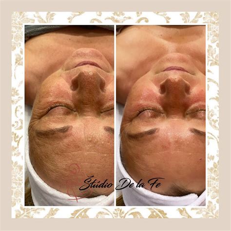 Porovnávacia fotografia pred a po použití séra, zobrazujúca redukciu vrások