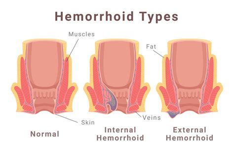 Ilustrácia znázorňujúca vnútorné a vonkajšie hemoroidy
