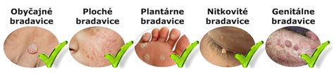 Infografika porovnávajúca rôzne typy bradavíc