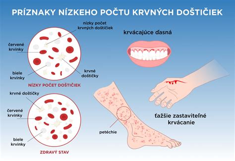 Ilustrácia znázorňujúca typické psoriatické ložiská na koži, červené s bielymi šupinami
