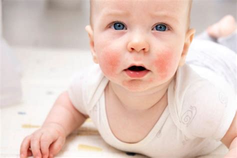 Ilustrácia rôznych štádií atopického ekzému na tvári u detí a dospelých