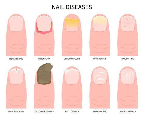 Ilustrácia znázorňujúca rôzne typy poškodenia nechtov (štiepenie, lámanie, odlupovanie)