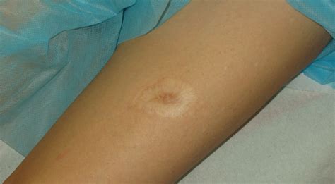 Porovnanie hypertrofickej a keloidnej jazvy