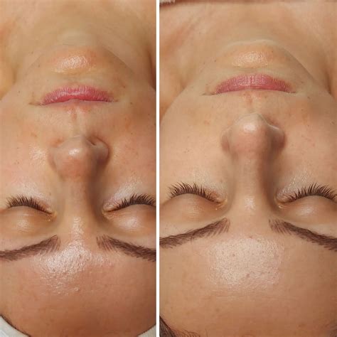 Fotografia pred a po ošetrení mikroihličkovou frakčnou rádiofrekvenciou.