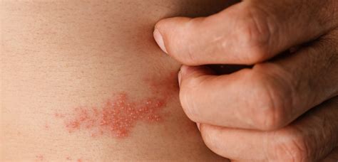 Ilustrácia porovnania planých neštovíc a pásového oparu