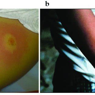 Ilustrácia vyrážky erythema migrans (býčie oko)