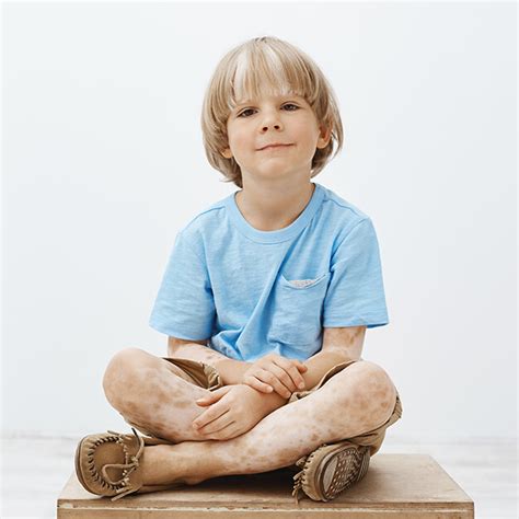 Infografika zobrazujúca rozloženie bielych škvŕn vitiliga na tele