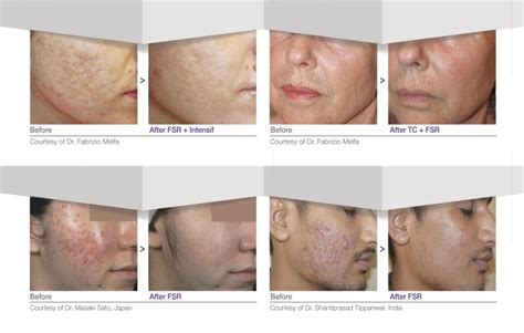 Porovnanie pleti pred a po ošetrení pigmentových škvŕn