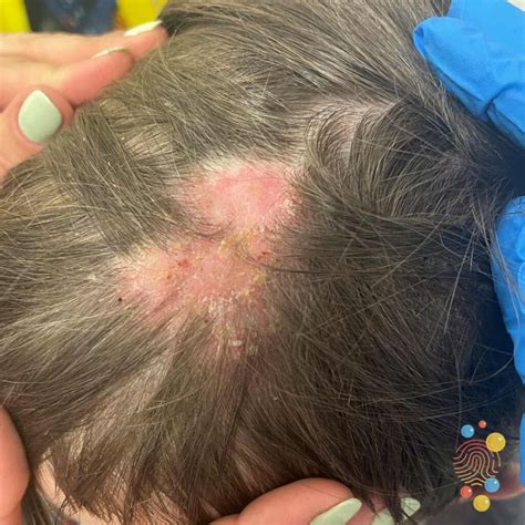 Ilustrácia mikroskopických húb spôsobujúcich tinea capitis