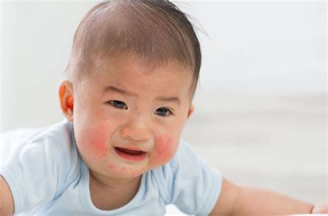 Ilustrácia dieťaťa s vyrážkou v oblasti plienky.