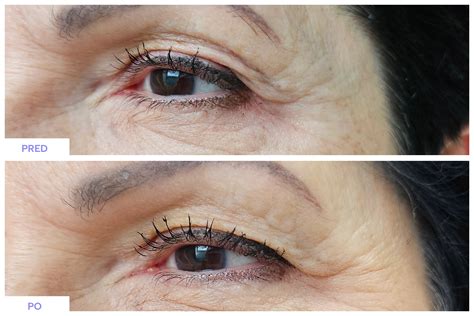 Porovnávacie fotografie pred a po ošetrení poklesnutých viečok plazmou