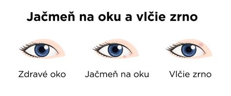 Infografika: Rozdiel medzi bežným pupienkom a vredom