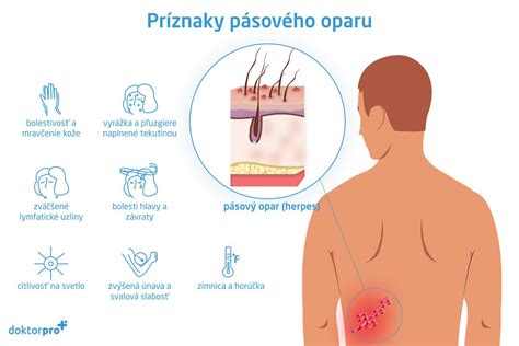 ilustrácia pásového oparu s typickými pľuzgierikmi na koži