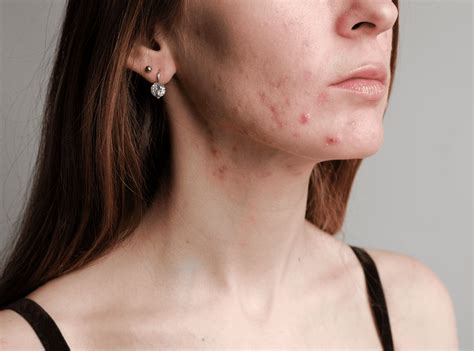 ilustrácia znázorňujúca oblasti tela, kde sa najčastejšie vyskytuje akné, s uvedením možných príčin