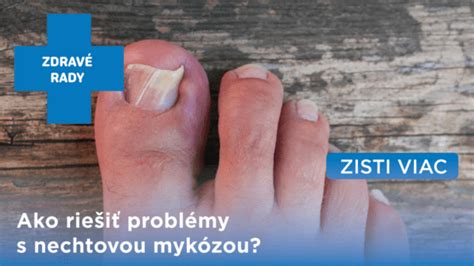 Ilustrácia nechtovej mykózy s detailným zobrazením postihnutého nechtu.