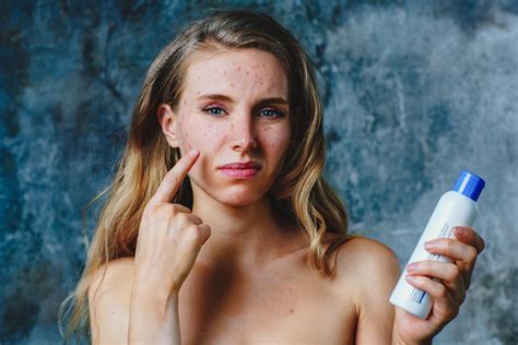 Ilustrácia kožnej reakcie pri dermatografii