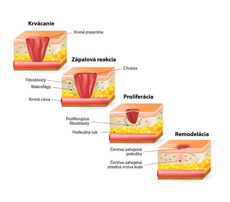 infografika zobrazujúca fázy hojenia jazvy