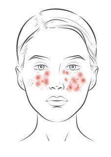 Schéma ukazujúca rôzne možnosti liečby hormonálneho akné.