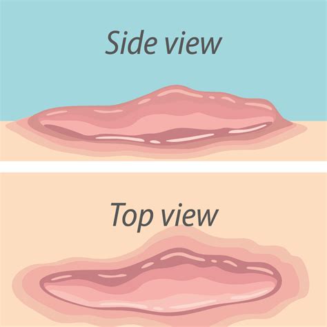 Ilustrácia rôznych typov jaziev: prirodzená, atrofická, hypertrofická, keloidná