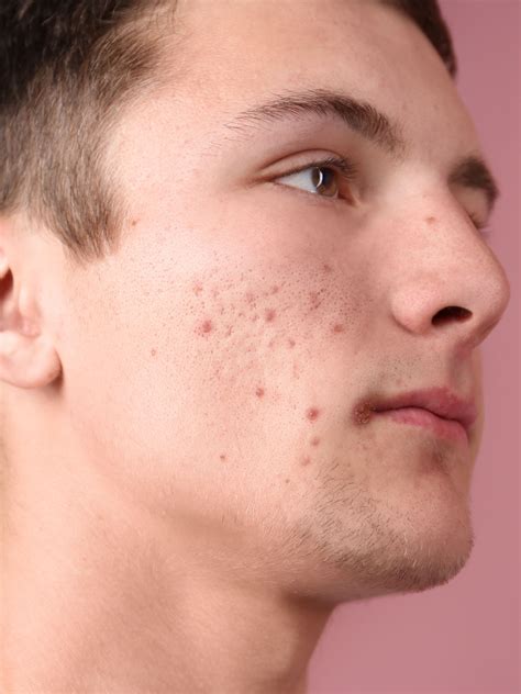 Portrét ženy s akné v oblasti brady a čeľuste.