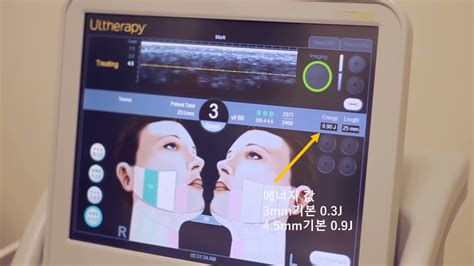 schéma aplikácie ultrazvukovej energie pri Ultherapy