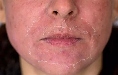 Osoba s mierne začervenanou tvárou po chemickom peelingu