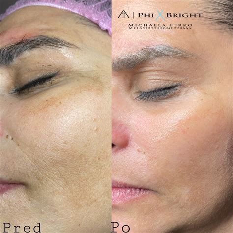 Koláž fotografií pred a po použití dermarolleru na rôzne problémy pleti (vrásky, jazvy, strie)